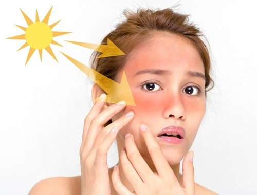درمان آفتاب سوختگی
